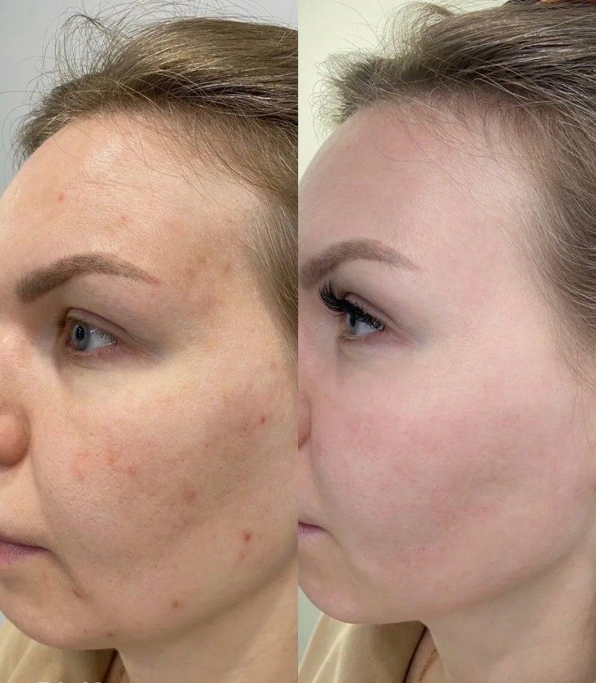 Advanced-Acne-Scar-Removal-Treatments-in-London