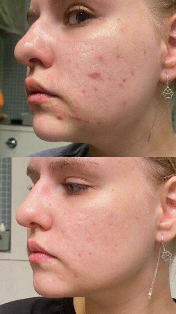 Advanced-Acne-Treatment-in-London