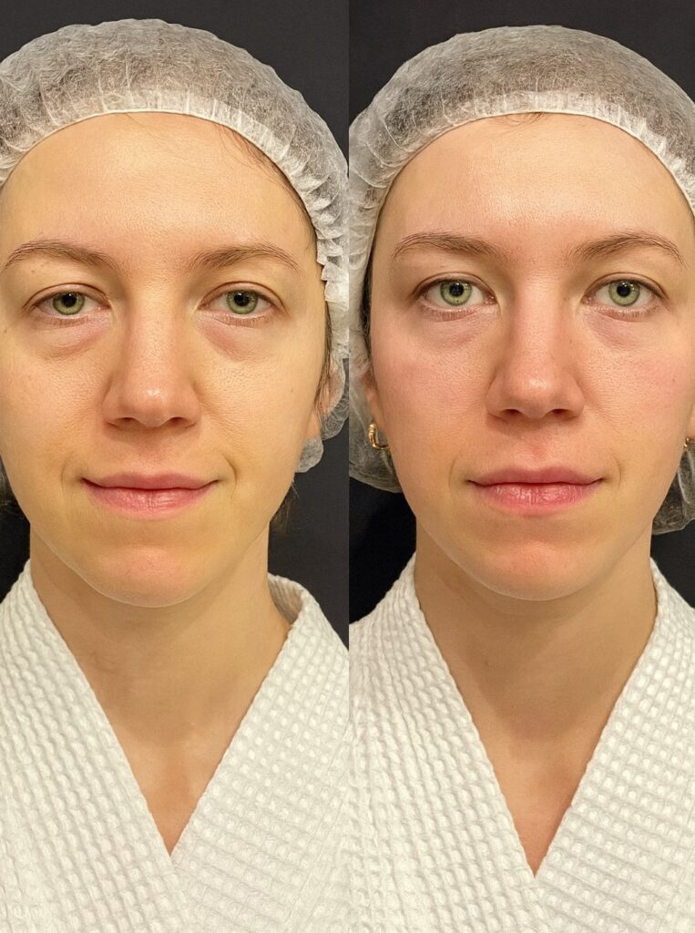 Before-After-Full-Face-Fillers