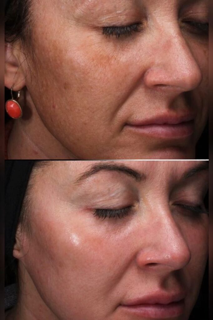 Before-After-Transform-Your-Skin