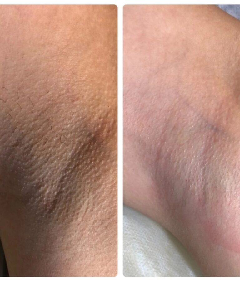 Before-after-Botox-for-Hyperhidrosis-Treatments