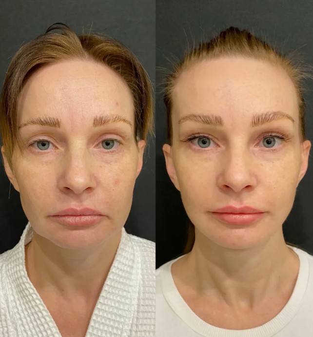 Before-and-After-Barbie-Botox-Treatment