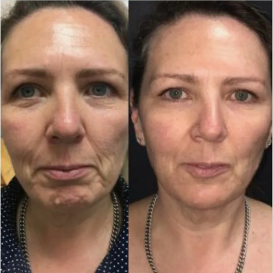 Before-and-After-Botox-for-TMJ-and-Bruxism-Treatment