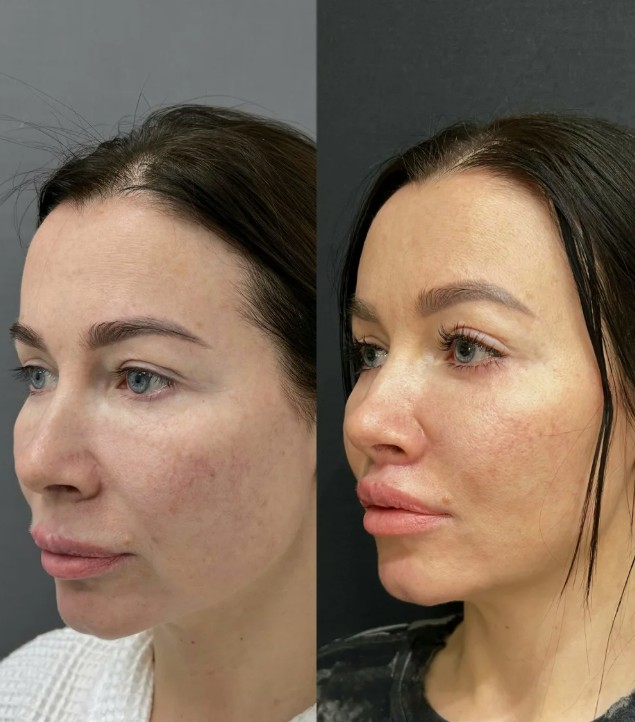 Before-and-After-Cheek-Filler-Treatment