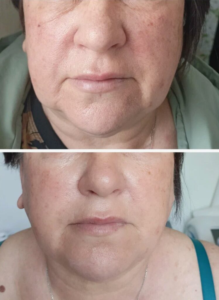 Before-and-After-Dermapen-Treatment