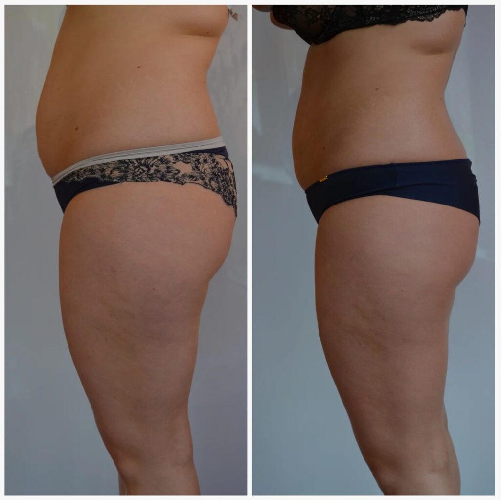 Before-and-After-Exilis-Body-Treatment