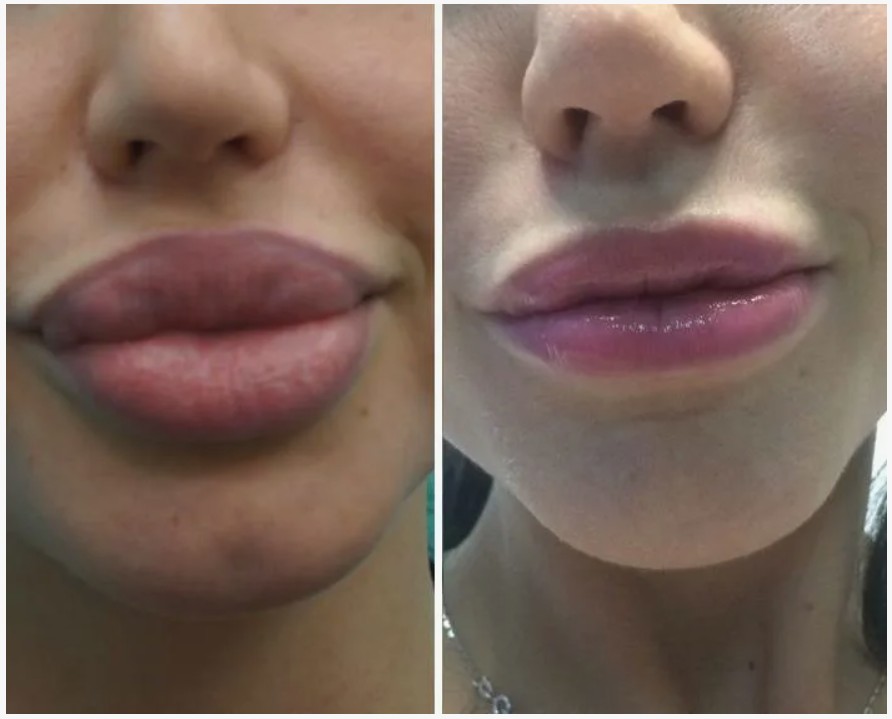 Before-and-After-Filler-Dissolving-Treatment