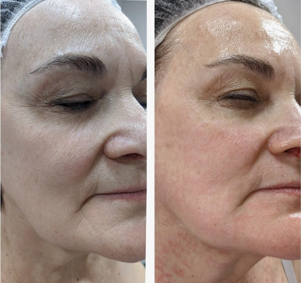 Before-and-After-Forma-RF-Treatment