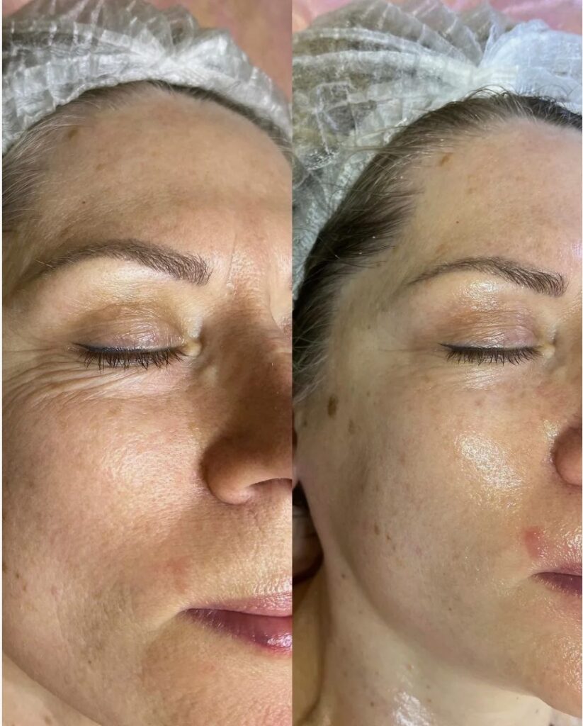 Before-and-After-Glow-Go-Facial