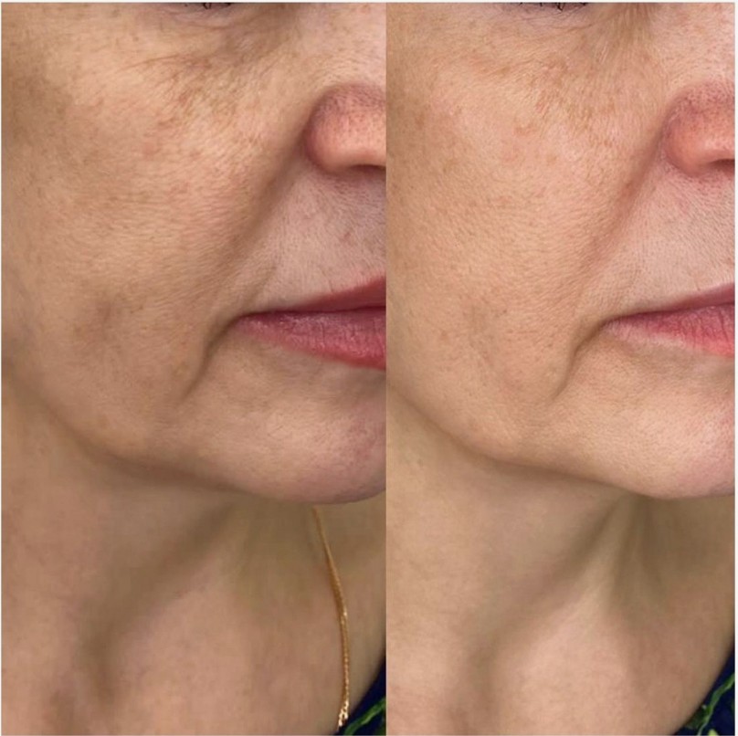 Before-and-After-Hyamax-Results-in-London