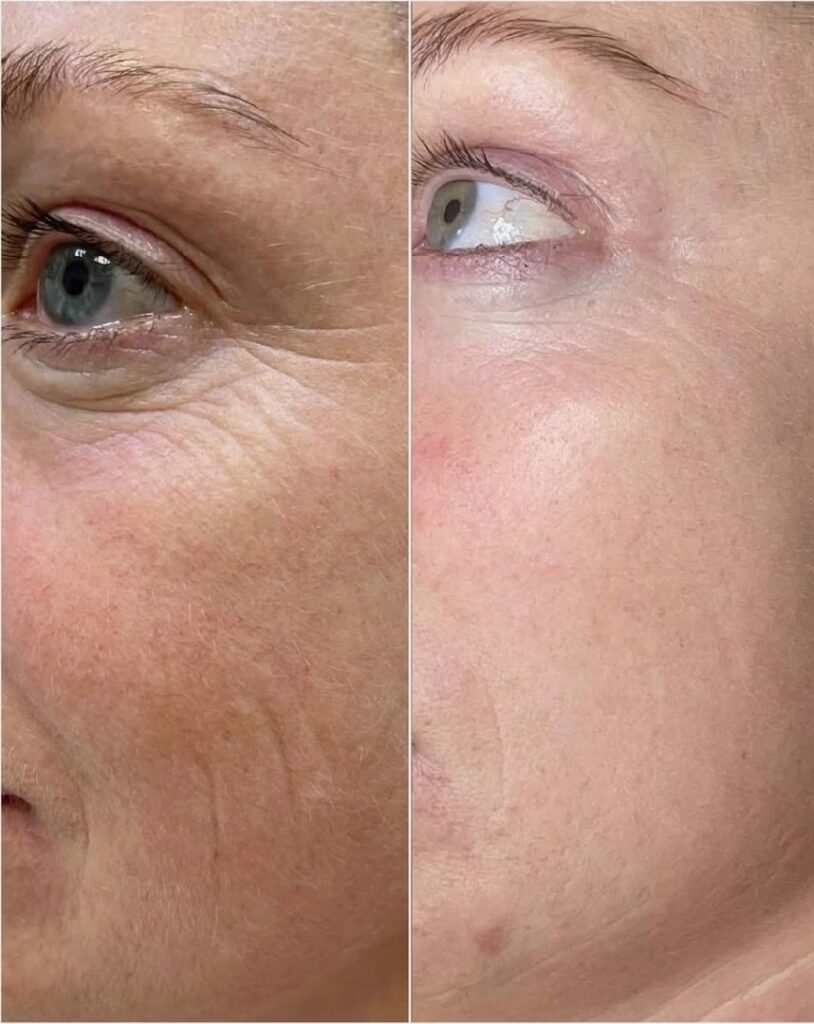 Before-and-After-Lumecca-IPL