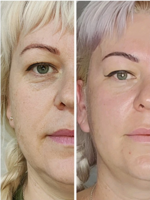 Before-and-After-Mesotherapy-Treatment