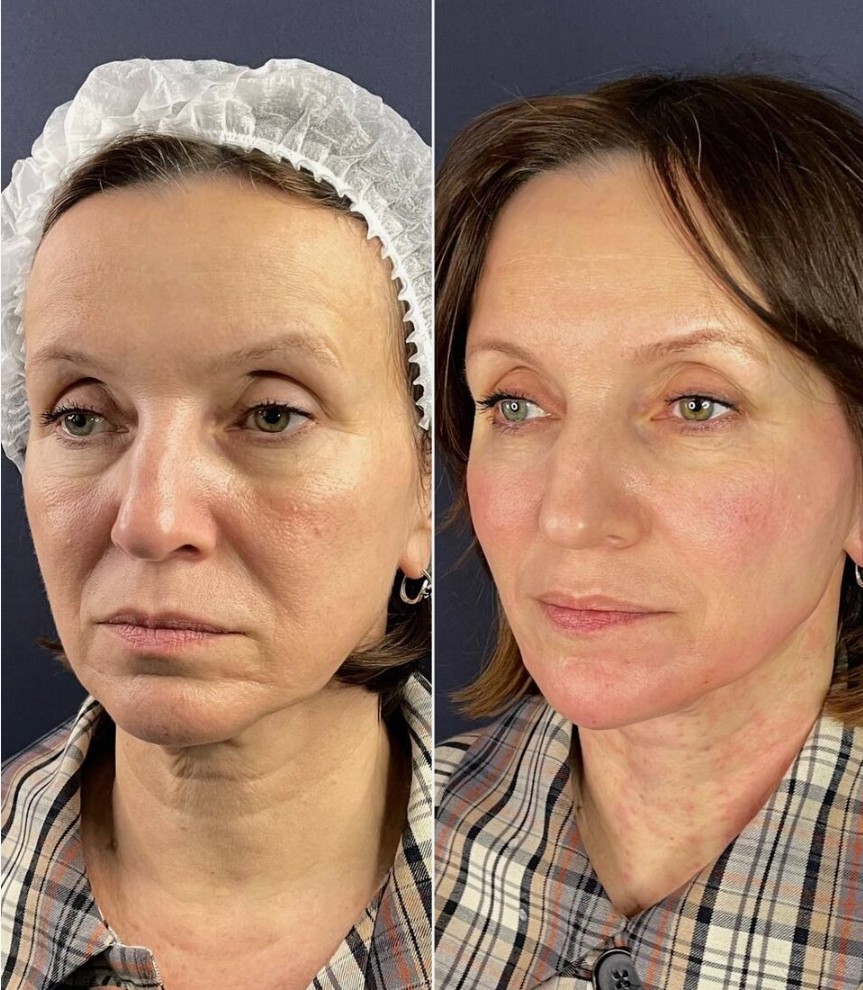 Before-and-After-Neuramis-Results-in-London