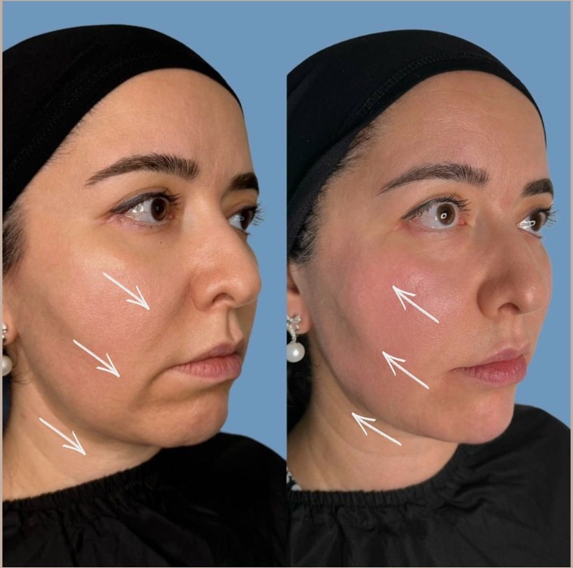 Before-and-After-Nucleofill-Treatment