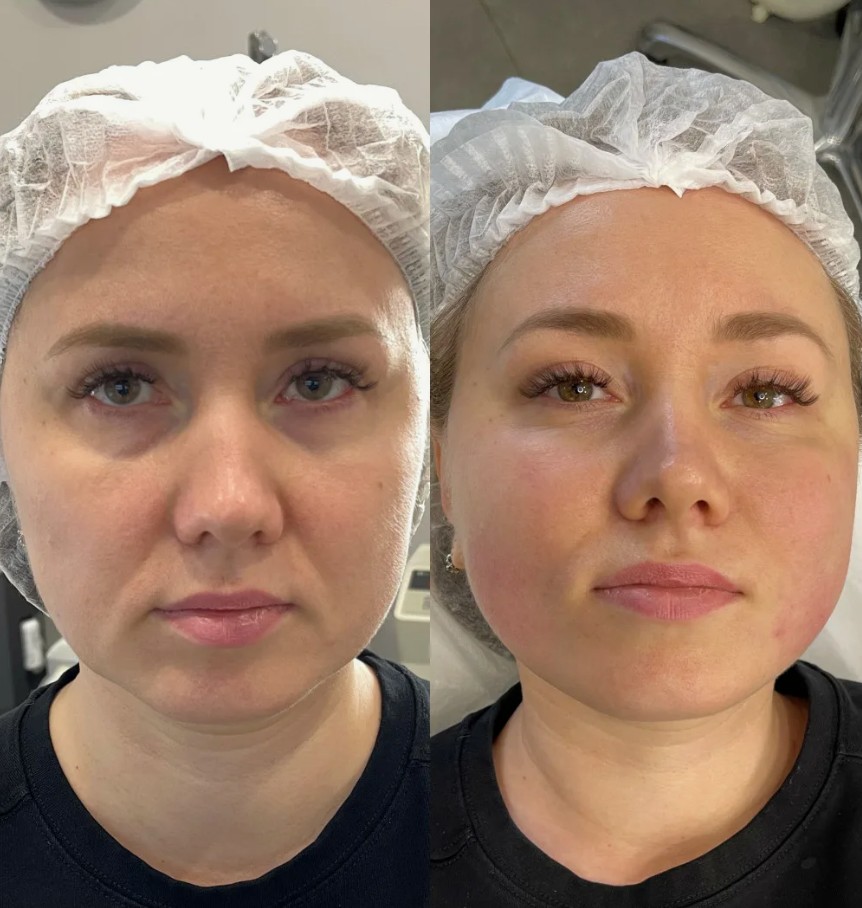 Before-and-After-Profhilo-Structura-Treatment
