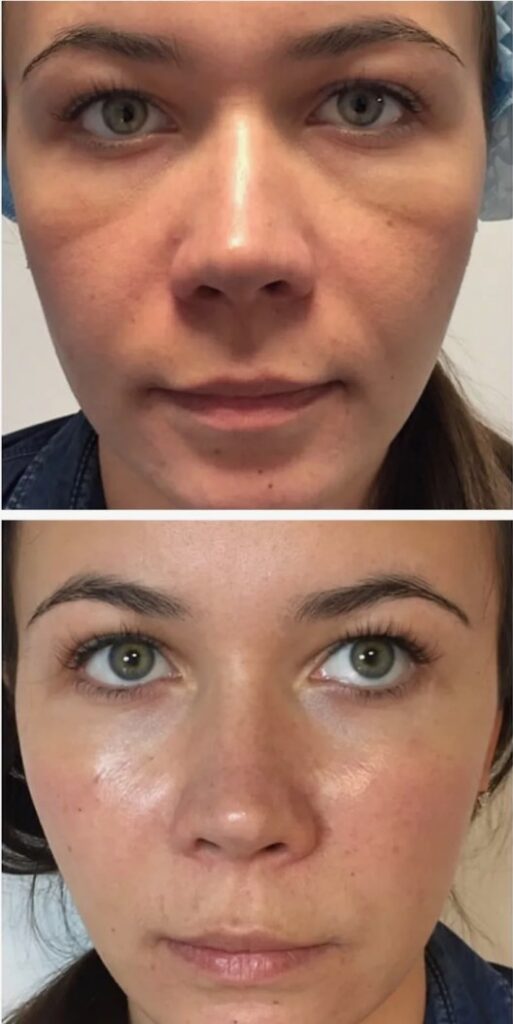 Before-and-After-Redensity-2-Results-in-London