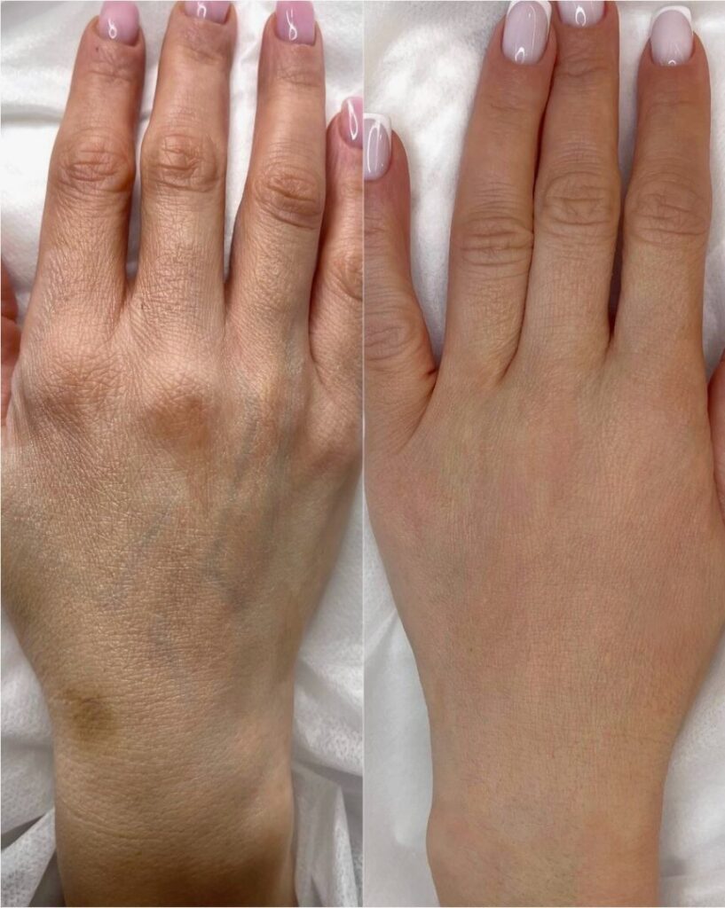 Before-and-After-Results-Rejuvenate