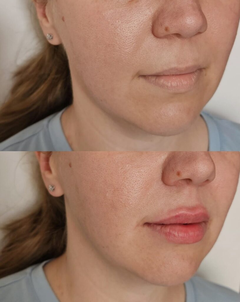 Before-and-After-Revanesse-Results-in-London