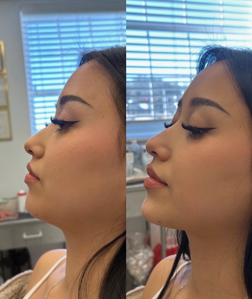 Before-and-After-Saypha-Results-in-London