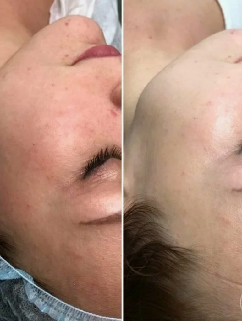 Before-and-After-Skin-Whitening-Treatment