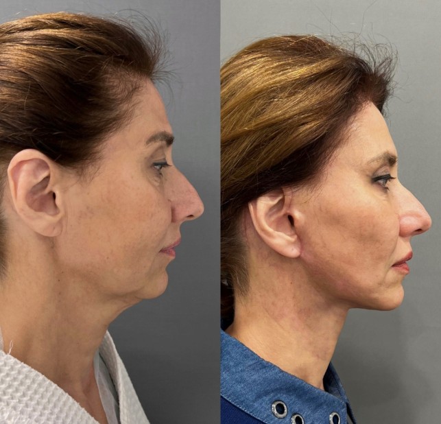 Before-and-After-Temple-Filler