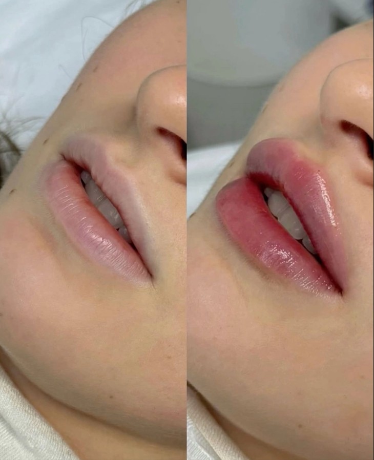 Before-and-After-Teosyal-Results-in-London