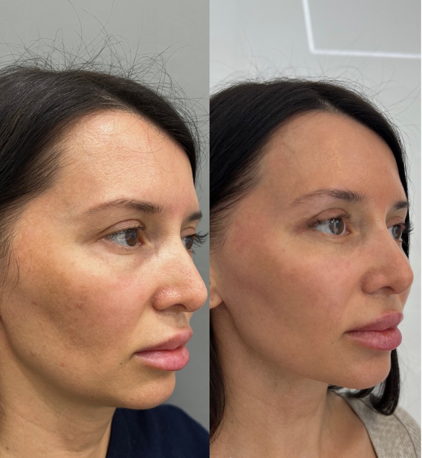 Before-and-After-Vampire-Facelift