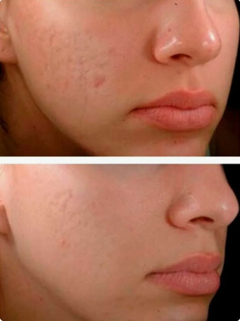 Before-and-After-Visible-Reduction-in-Acne-Scarring