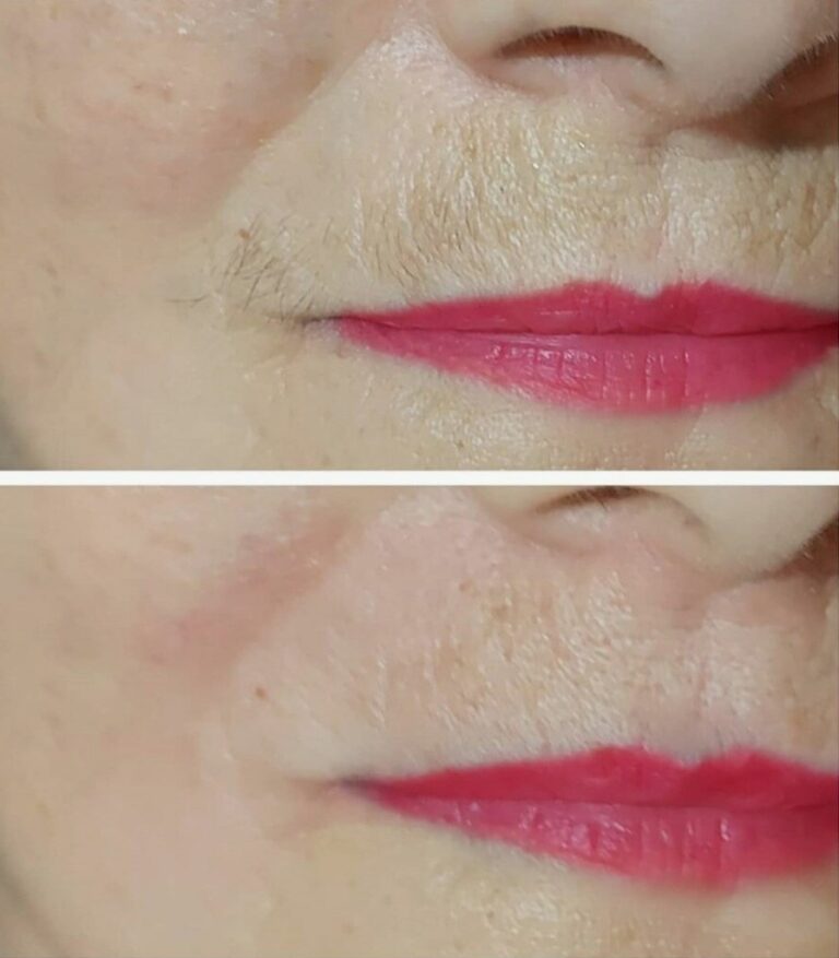 Before-and-after-Laser-Hair-Removal