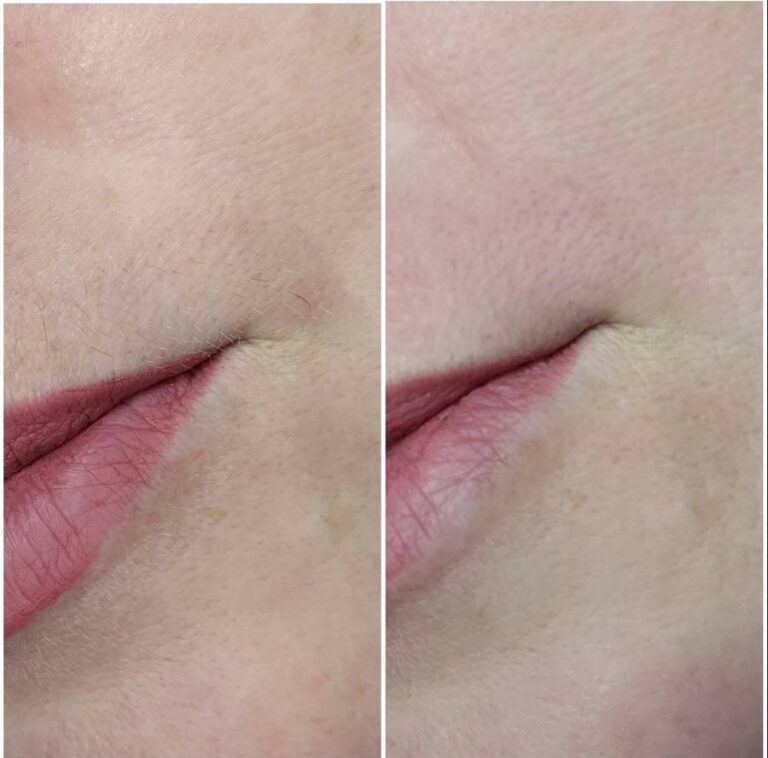 Before-and-after-Laser-Hair-Removal-showing-smoother-skin-near-the-lips.