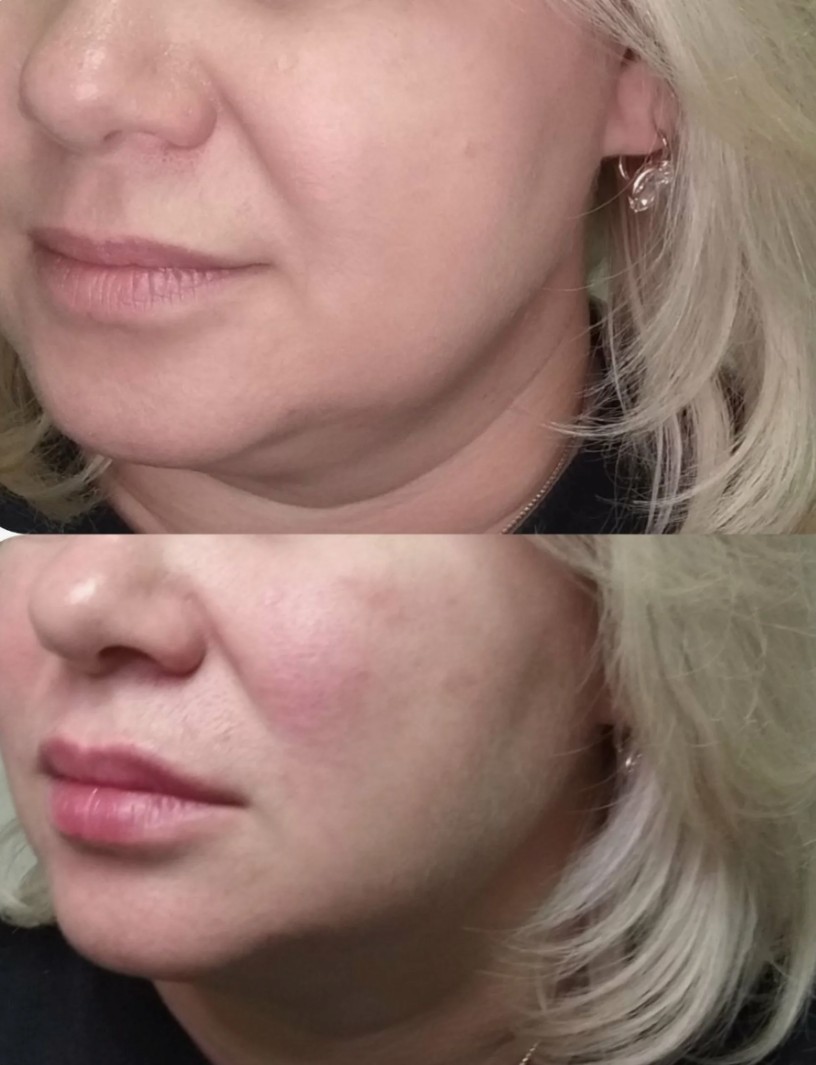 Bellafill-Filler-in-London