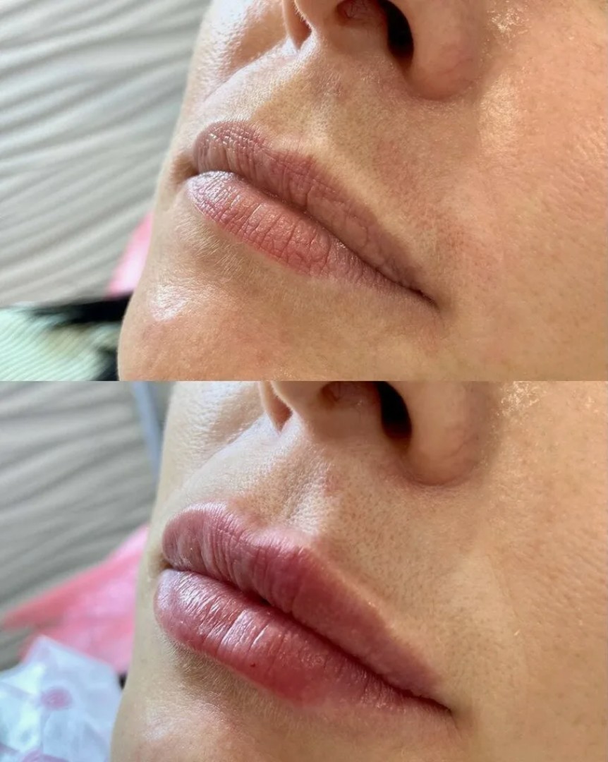 Belotero-Filler-in-London