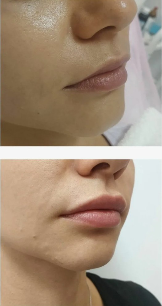 Benefits-of-Belotero-Filler