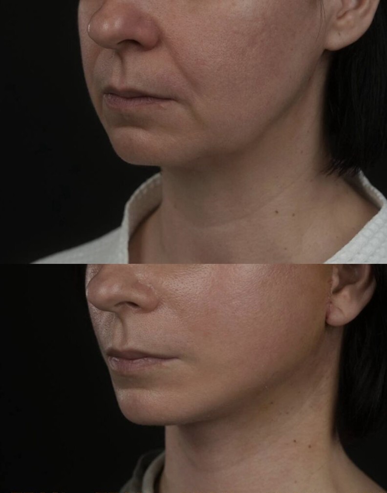 Benefits-of-Ellansé-Filler