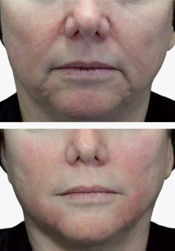 Benefits-of-Neuramis-Filler