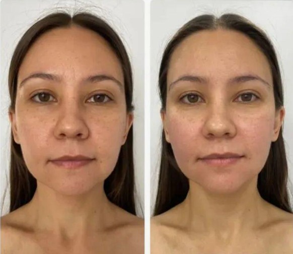 Benefits-of-Redensity-1-Skin-Booster