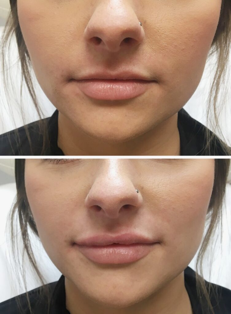 Benefits-of-Revolax-Filler