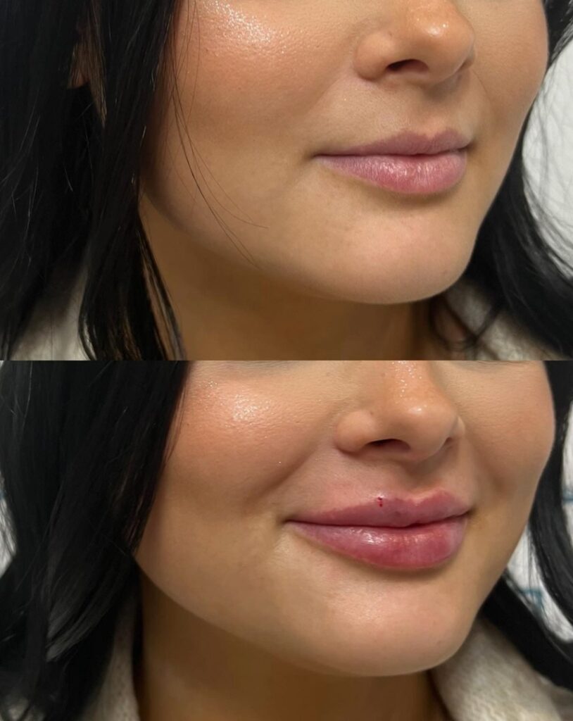 Benefits-of-Saypha-Filler