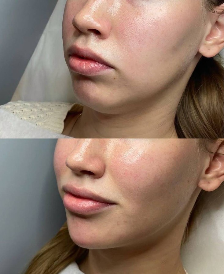 Benefits-of-Teosyal-Filler