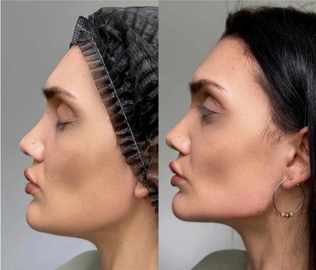 Botox-for-Jaw-Slimming-Treatments