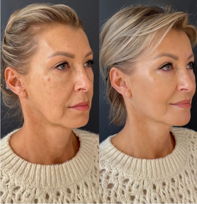 Botox-for-TMJ-and-Bruxism-Treatments