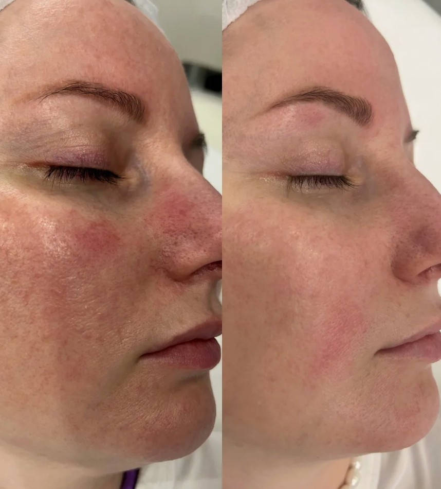Comprehensive-Rosacea-Treatment-in-London