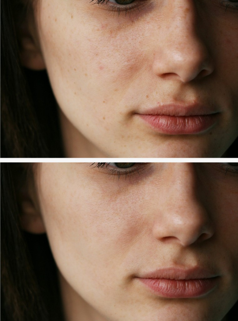 Cosmelan-Peel-Treatment-Professional-Depigmentation-in-London