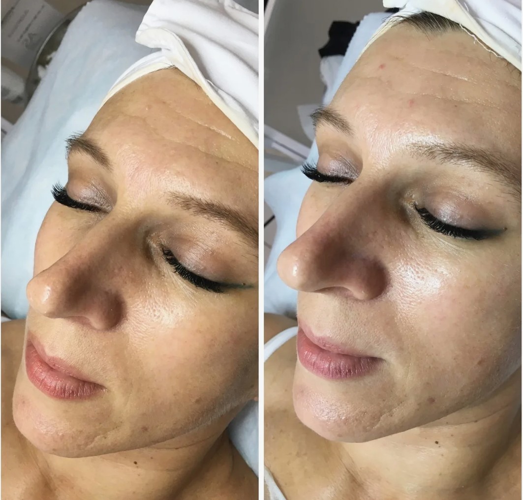 Deluxe-HydraFacial-Treatments