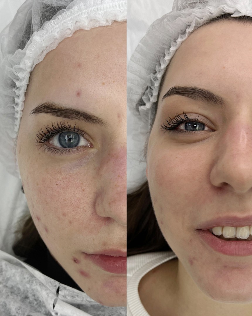 Dermapen-Treatments-in-London