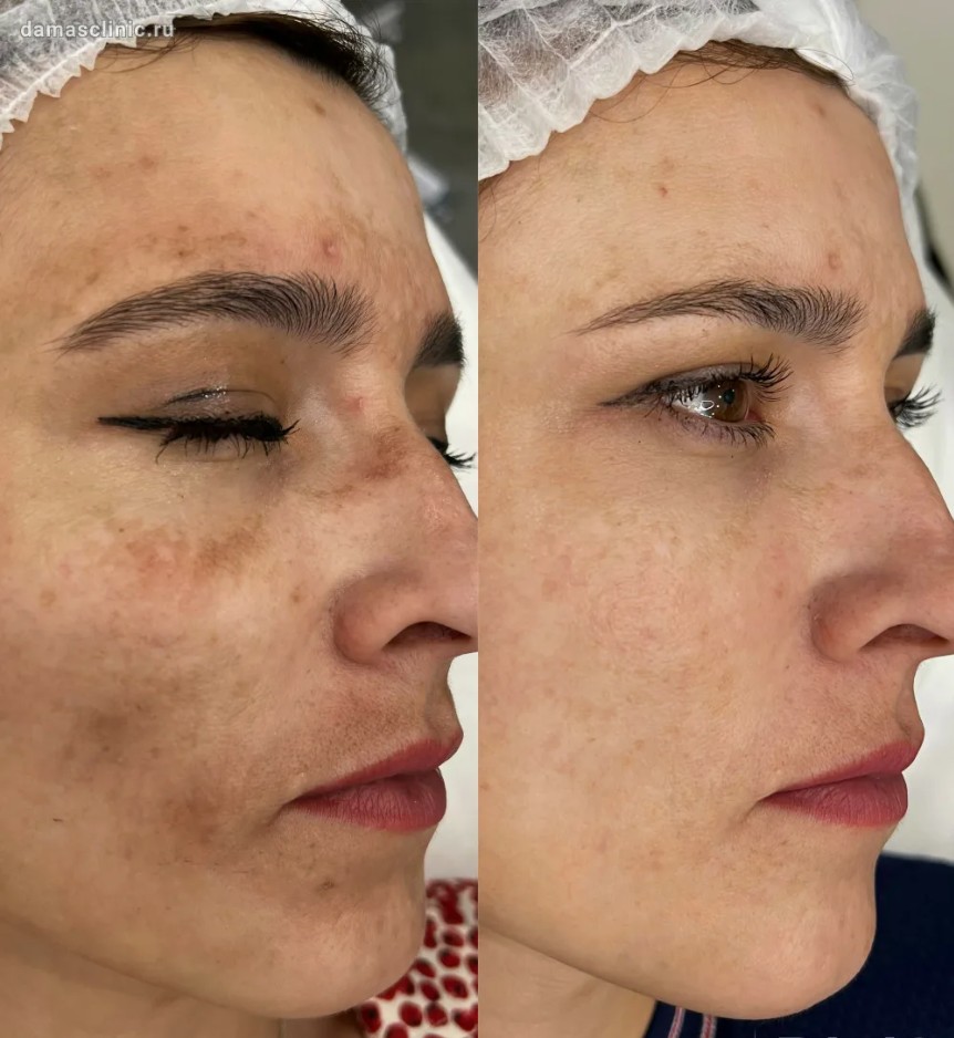 Effective-Age-Spot-Removal-London's-Premier-Skin-Clinic