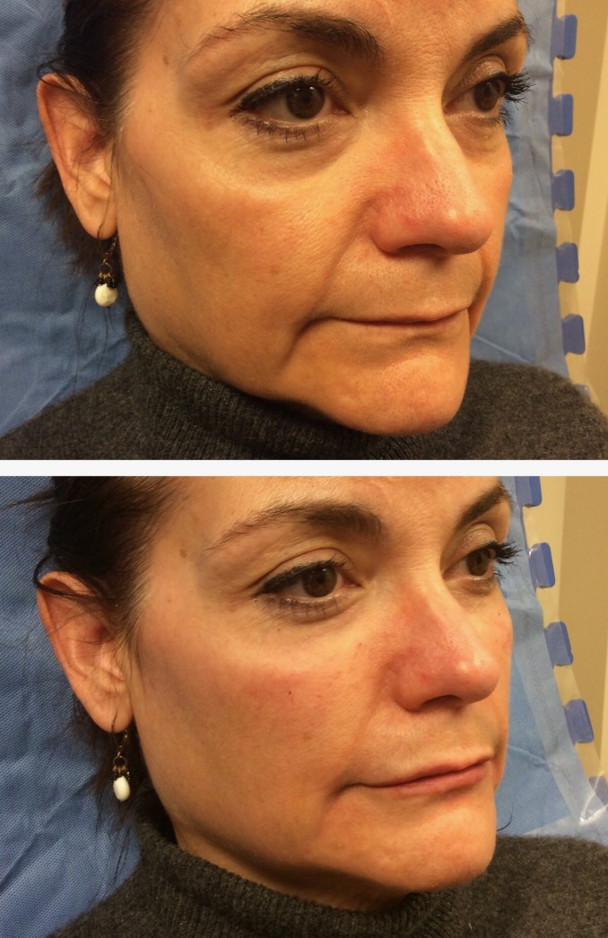 Ellansé-Filler-in-London