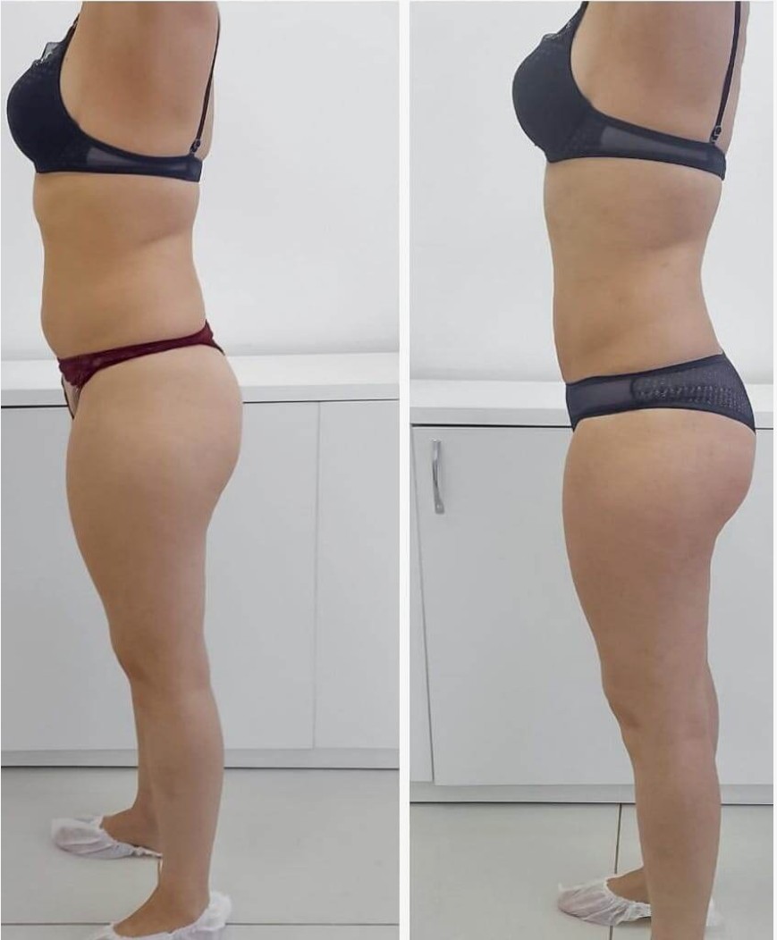Exilis-Body-Treatments