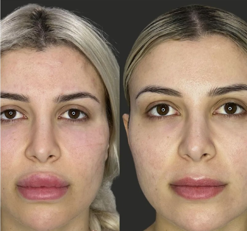 Filler-Dissolving-Treatments