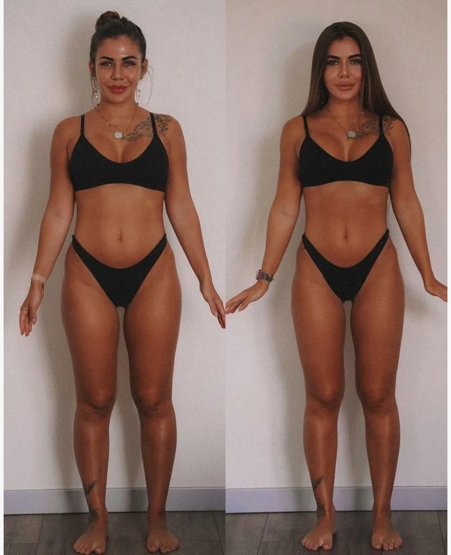 Forma-Body-contouring-treatment-on-abdomen-at-London-clinic